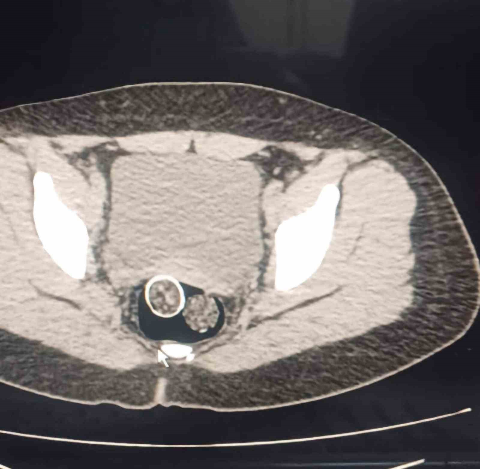 320 gram uyuşturucuyu mide ve rahme sakladılar
